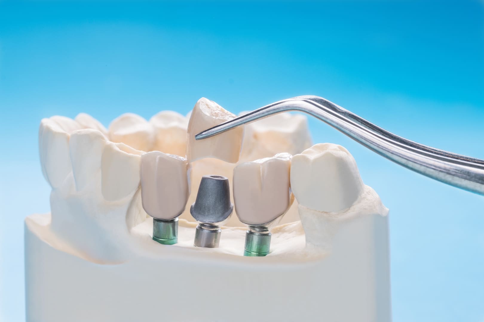 Implant Retained Dentures In Brentwood Liberty Dental Group